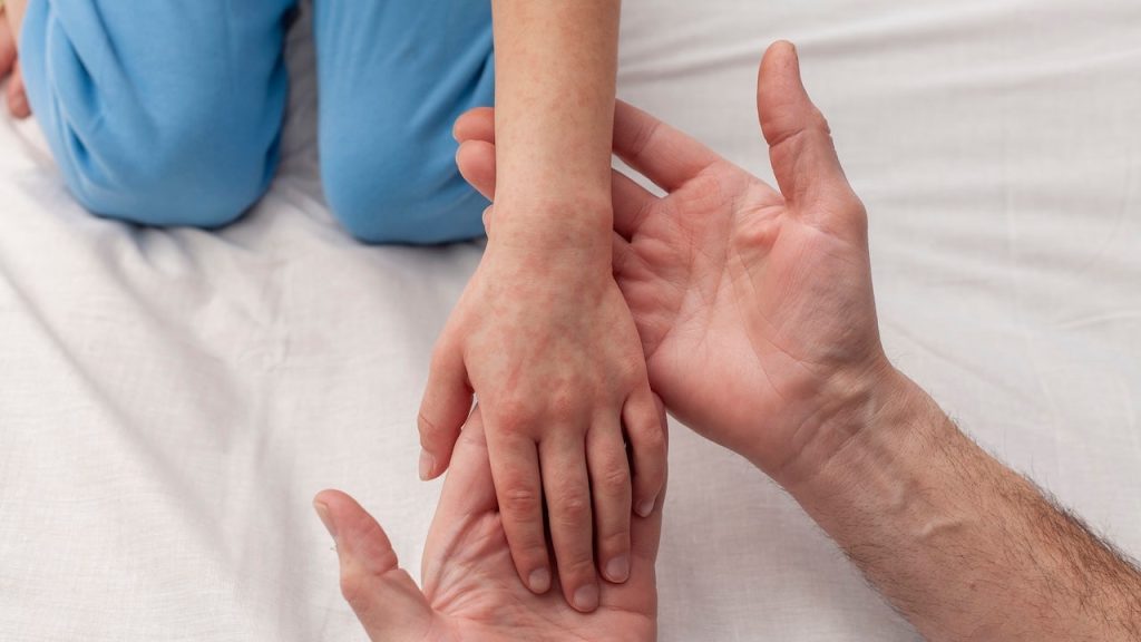 Measles outbreak forces 254 people into quarantine in South Carolina county